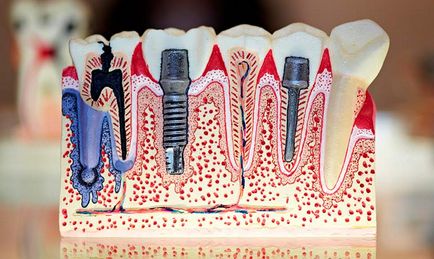 Implanturi dentare fotografie, recenzii, preț, ghid dentar