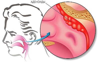 Adenoidele din nas ceea ce este