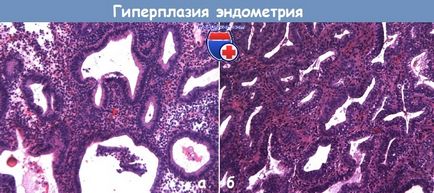 Hiperplazia atipică a endometrului uterului