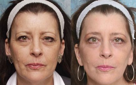 Atraumatikus tisztító az arc (fotók előtt és után az eljárást)