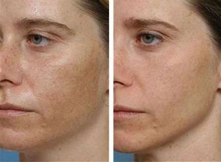 Атравматична чистка обличчя (фото до і після процедури)