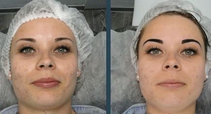 Atraumatikus tisztító az arc (fotók előtt és után az eljárást)