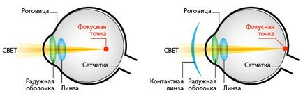 Короткозорість як відновити зір і вилікувати очі