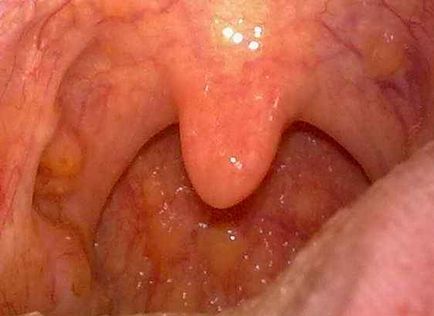 Durere în gât în ​​timpul înghițitului și tratament cu medicamente populare