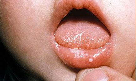 Болячки на губі у дитини