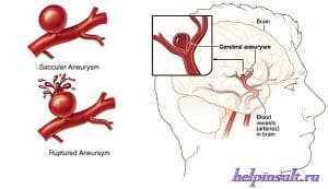 Чим небезпечна аневризма головного мозку