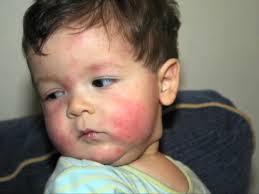 Copii alergici diatese, alergie