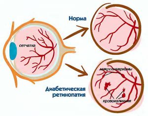 Діабетична макулопатія причини виникнення, що робити
