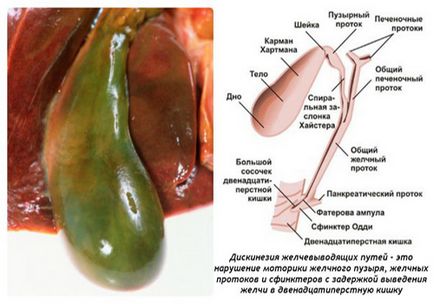 Dietă pentru diskinezia biliară, dietă terapeutică și meniuri pentru dischinezia zhvp