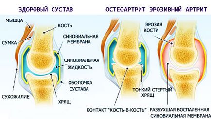 Erita artrita - eroziv-distrugeri ale articulatiilor