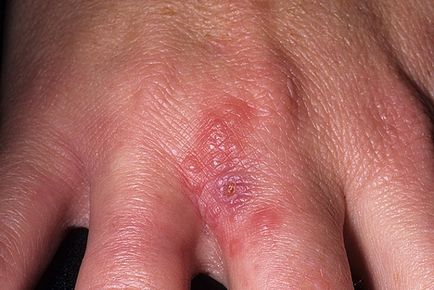 Herpesul dintre degete, tratament pe deget, palme, sub braț