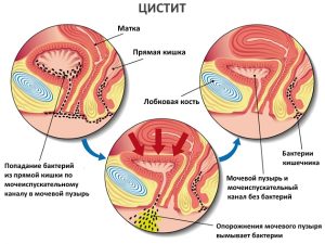 Герпетичний цистит симптоми і лікування