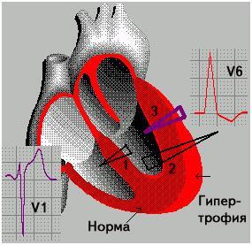 Гіпертрофія лівого шлуночка серця на ЕКГ