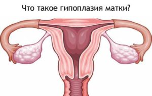 Hipoplazia simptomelor, gradului, diagnosticului și tratamentului uterului