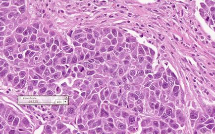 Tipuri histologice de cancer pulmonar