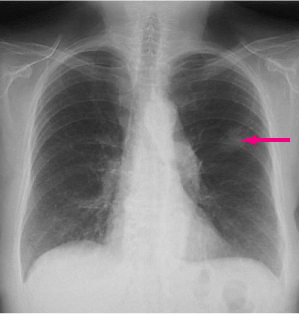 Tipuri histologice de cancer pulmonar