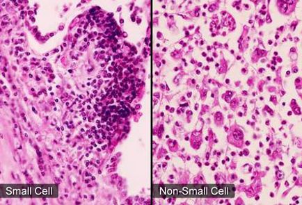 Tipuri histologice de cancer pulmonar