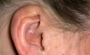 Ciuperca in urechi (otomicoza) la om - simptome si tratament