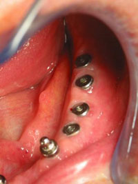 імпланти зубні