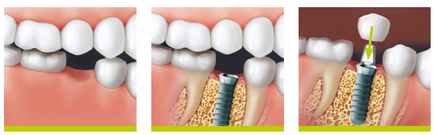 Implanturi dentare - clinică stomatologică - clinică stomatologică