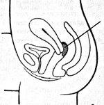 Чуждо тяло вагина - причини, симптоми, диагностика и лечение