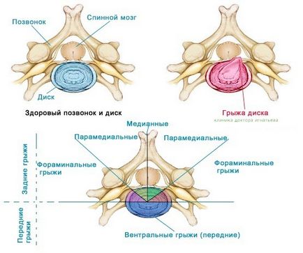 Які бувають види міжхребцевих гриж хребта