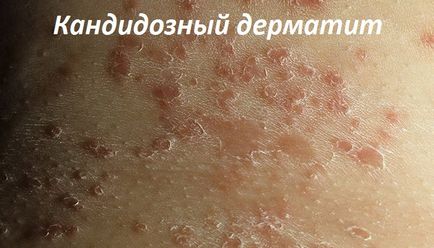 candida dermatitis