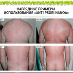 Candidiasis dermatitis