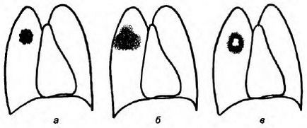 Clasificarea cancerului pulmonar, portal medical