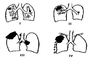 Klassifkatsiya tüdőrák - morfológiai (szövettani), anatómiai, TNM, valgsg