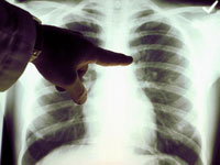 Clasificarea cancerului pulmonar - morfologic (histologic), anatomic, tnm, valgsg