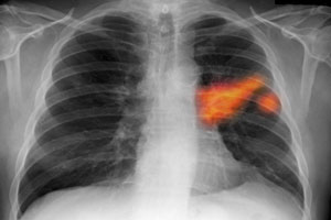 Clasificarea cancerului pulmonar - morfologic (histologic), anatomic, tnm, valgsg