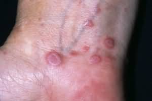 Tratamentul roșu de lichen, cauze, simptome