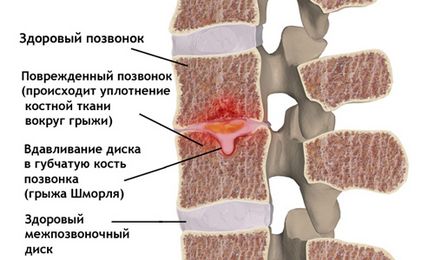 Лечение на херния SHmorlja