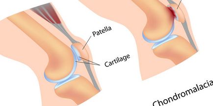 Tratamentul sinovitis al simptomelor articulației genunchiului, remedii folclorice