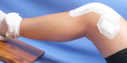 Лікування синовіту колінного суглоба симптоми, народні засоби