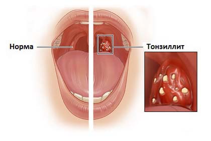 Лікування тонзиліту методами аюрведи