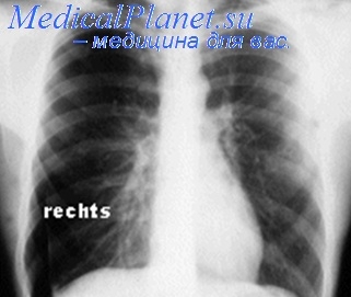 Formații buloase pulmonare