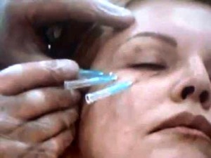 Ліфтіноговие нитки для підтяжки обличчя які види ниток використовуються в косметології
