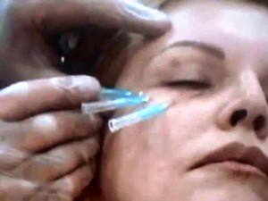 Liftinogovye szálak facelift milyen fonalakat használunk a kozmetikai (mi) Liftinogovye szálak facelift milyen fonalakat használunk a kozmetológiai