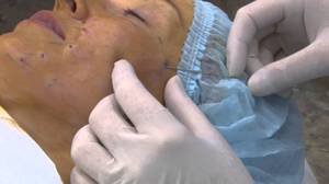 Liftinogovye szálak facelift milyen fonalakat használunk a kozmetikai (Face) Liftinogovye szálak facelift milyen fonalakat használunk a kozmetológiai