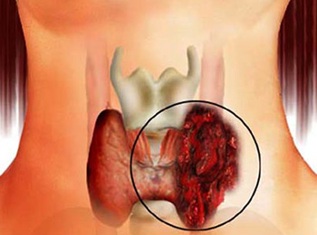 Місцево-поширений рак щитовидної залози, лікар сапріна оксана александровна