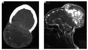 Cancer distribuit local la nivelul glandei tiroide, doctor saprin oxana alexandrovna