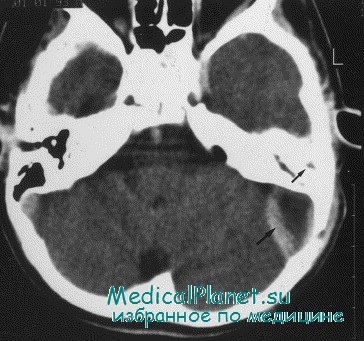 Morfologia și histologia abceselor cerebrale