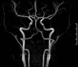 Artera carotidă arterială