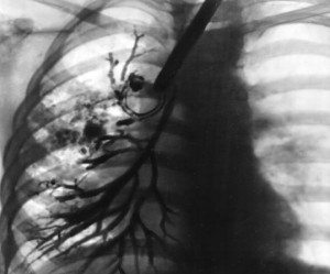 Fibroza chistică este ceea ce o fotografie de boală, istoricul bolii, boala pulmonară