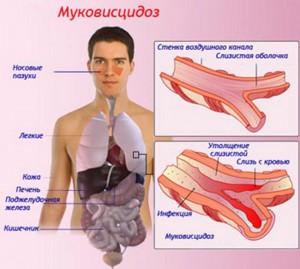 Fibroza chistică este ceea ce o fotografie de boală, istoricul bolii, boala pulmonară