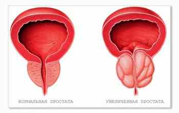 Rețete și plante populare din prostatită, cele mai populare fitopreparate pentru tratamentul prostatitei