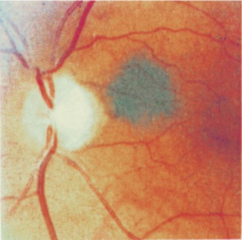 Nevus Choroid Eye Symptoms and Treatment