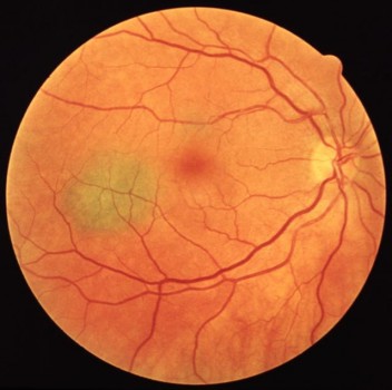 Nevus Choroid Eye Symptoms and Treatment